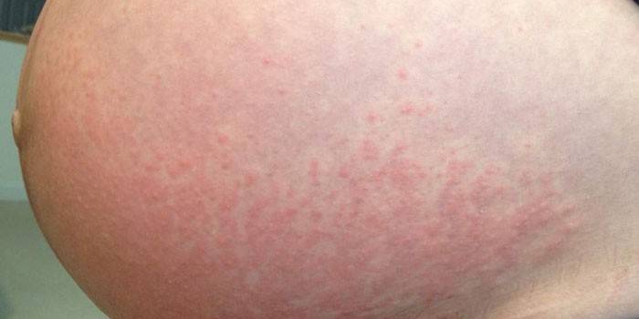 Dermatitída na koži brucha počas tehotenstva