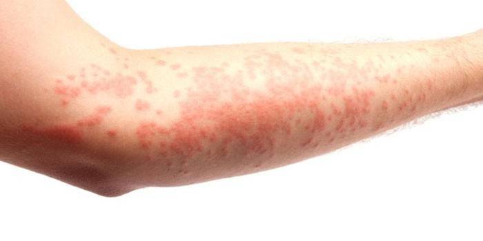 Urticaria po ruke