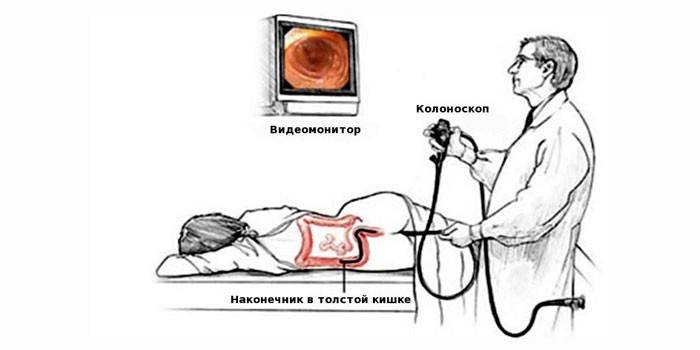 Esquema de Colonoscopia