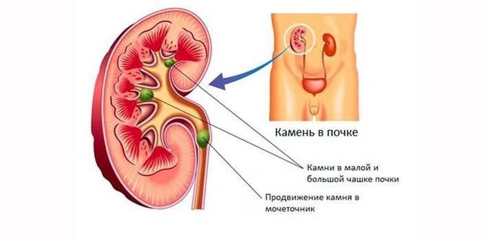 Urolitiasis