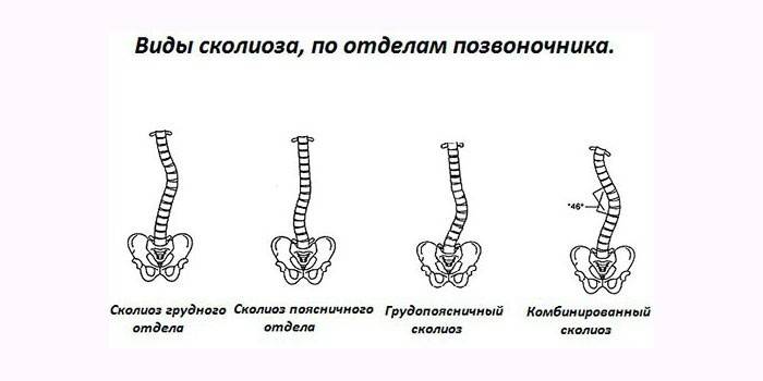 Tipos de enfermedades en la columna vertebral.