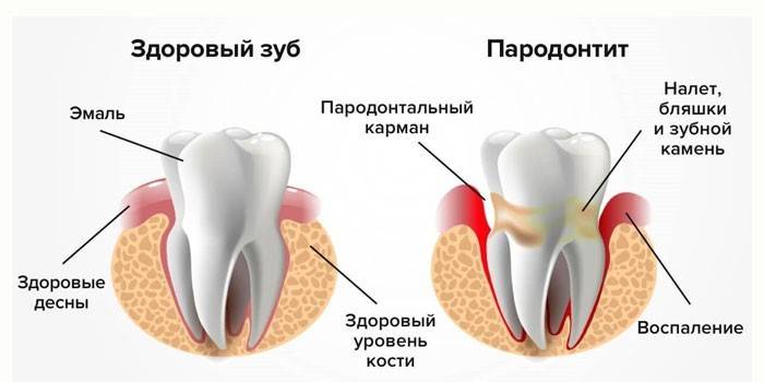 Dente saudável e periodontite