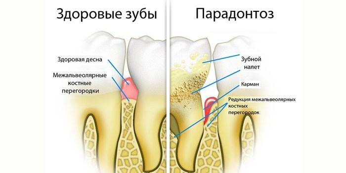 Manifestações da doença periodontal