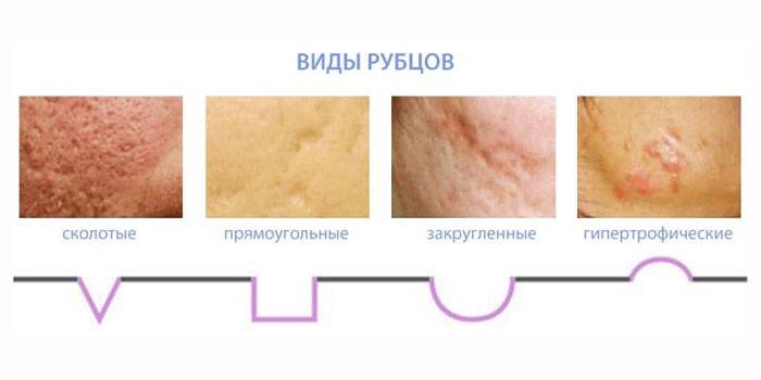 Druhy jaziev