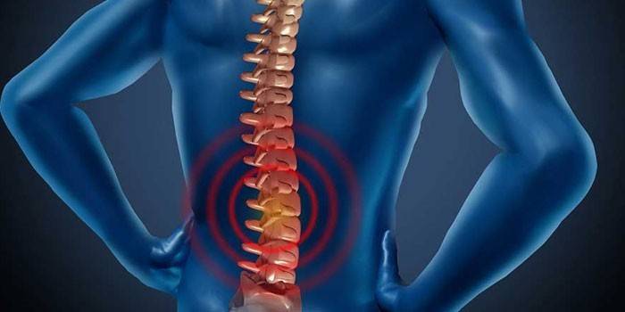 Dolor en la columna vertebral en humanos.