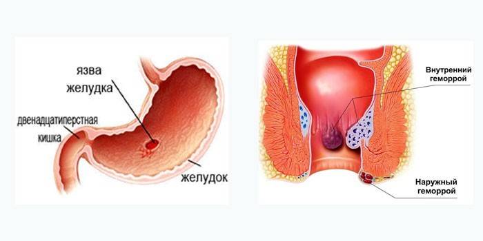 Indicaciones para la ozonoterapia en gastroenterología.
