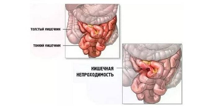 Obstrucción intestinal