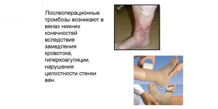 Trombosis postoperatoria de las extremidades inferiores