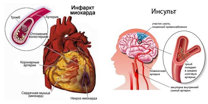 Ataque cardíaco e acidente vascular cerebral