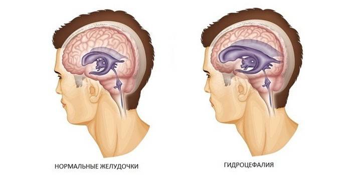 Ventrículos normales y agrandados del cerebro.