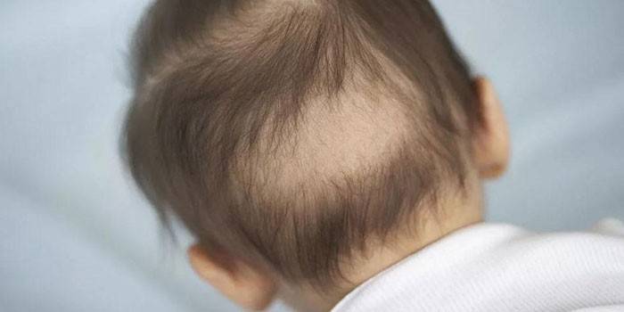 Microsporia en un niño