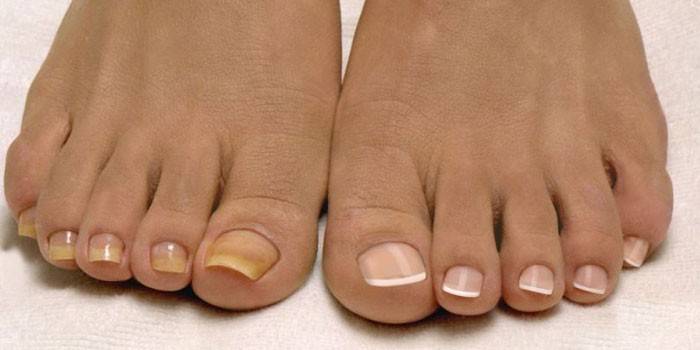 Uñas sanas y doloridas