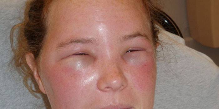 Edema de Quincke