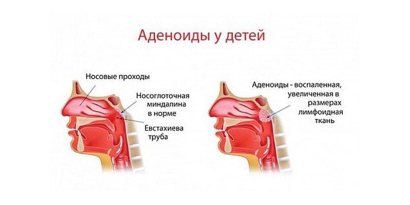 Adenoides en niños