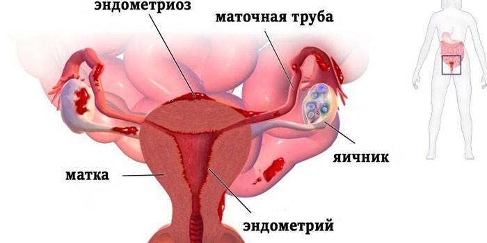 Schéma endometriózy maternice