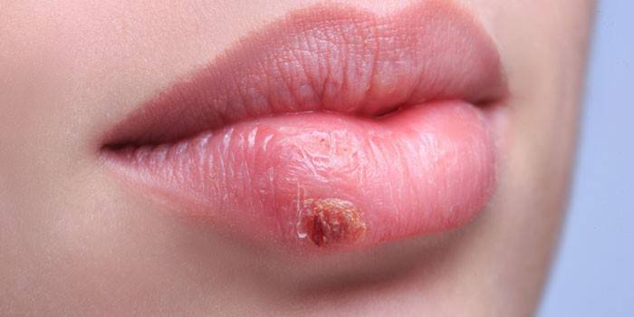 Herpes na pery dievčaťa