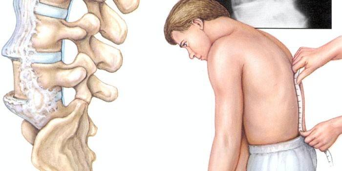 Espondilitis anquilosante
