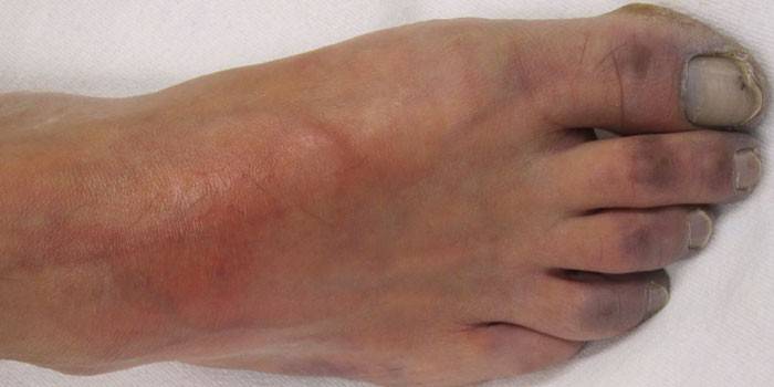 Endarteritis obliterante