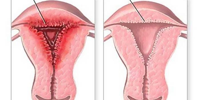 O esquema de hiperplasia endometrial uterina