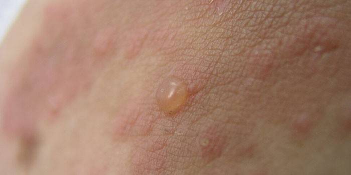 Dermatitis Dühring