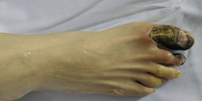 Gangrena del pie