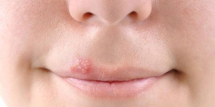 Herpes no lábio superior