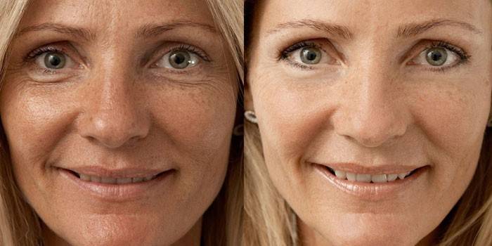 Foto de una mujer antes y después de Mesovarton