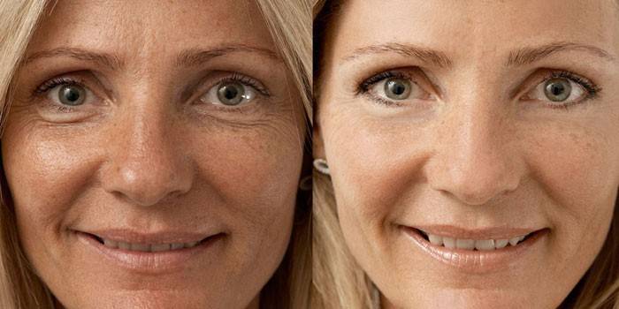 Rostro de la mujer antes y después de la biorevitalización.