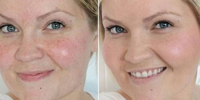 Pele no rosto de uma mulher antes e depois da limpeza por uma esteticista
