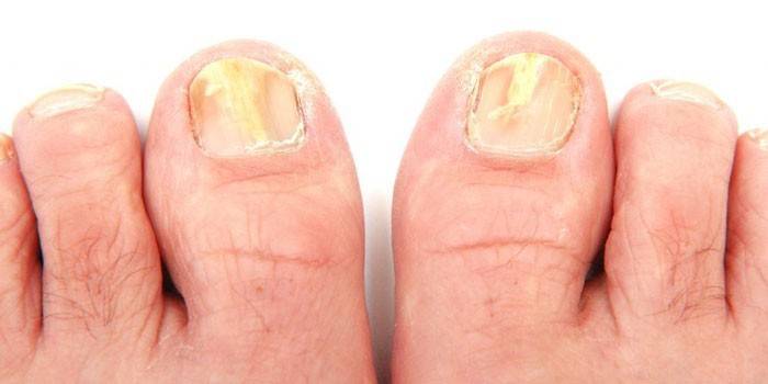 Toe unha fungo