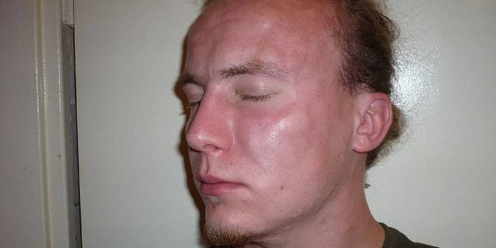 O edema de Quincke no rosto de um homem