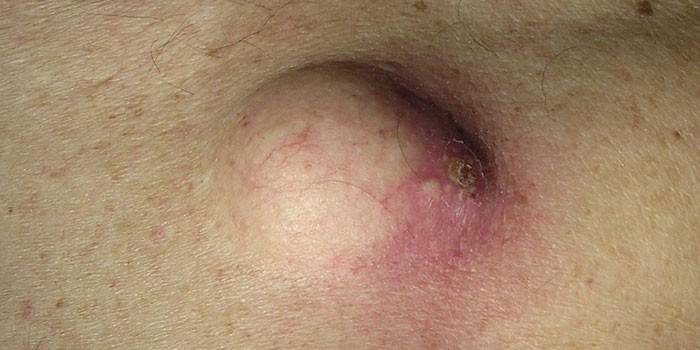 Atheroma fotka