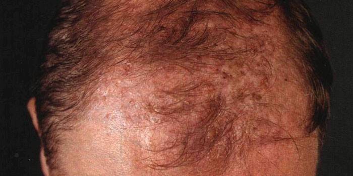 Favus scalp