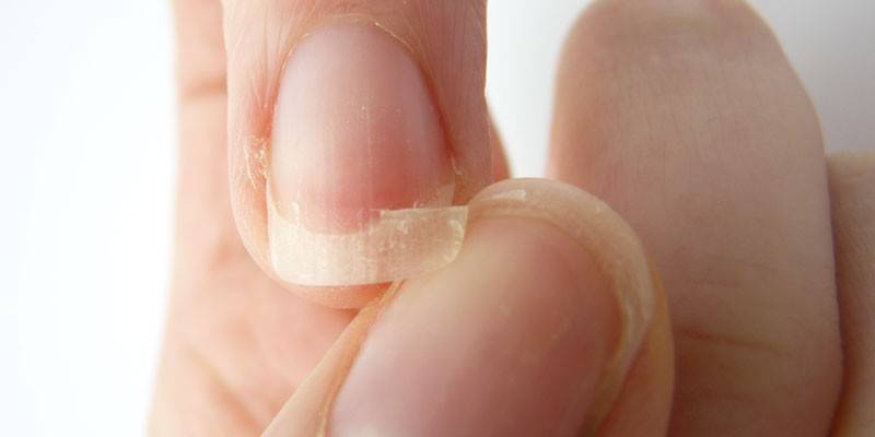 Unhas quebradiças