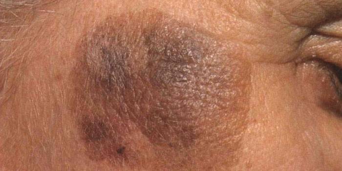 Keratoma senil no rosto de uma mulher
