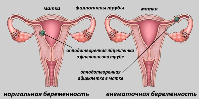 Normálne a mimomaternicové tehotenstvo