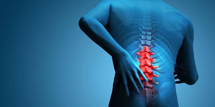 Dolor en la hernia intervertebral de la columna lumbar.