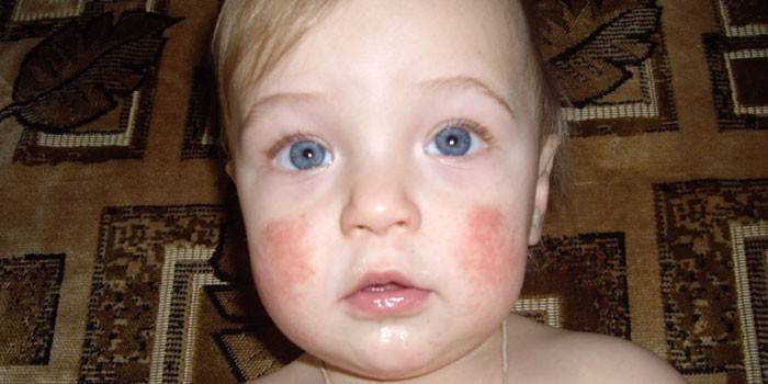 Dermatite atópica no rosto de uma criança