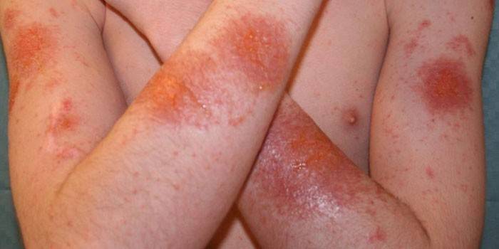 Pele afetada por dermatite esfoliativa de Ritter