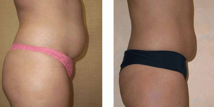 Abdomen de la niña antes y después de la cavitación.