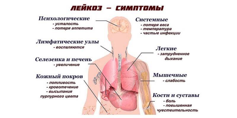 Síntomas de leucemia