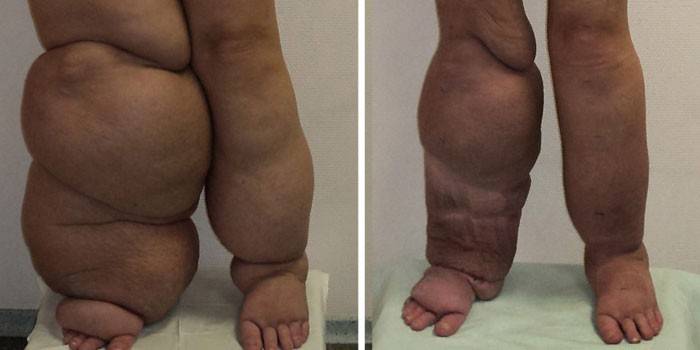 Linfedema das extremidades inferiores