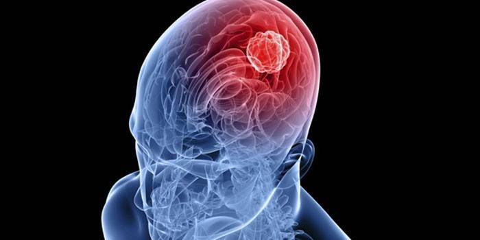 Tumor no cérebro humano
