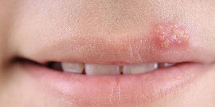 Herpes no lábio superior da menina