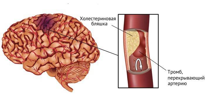 AVC isquêmico cerebral