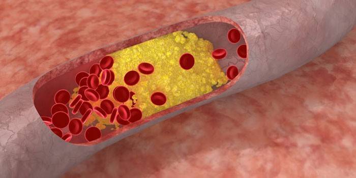 Naczyniowa płytka cholesterolu