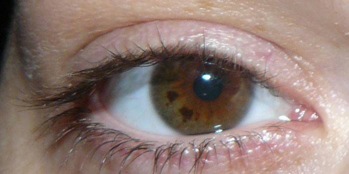 Pontos pretos nos olhos