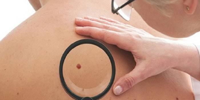 O médico examina uma toupeira nas costas do paciente através de uma lupa.