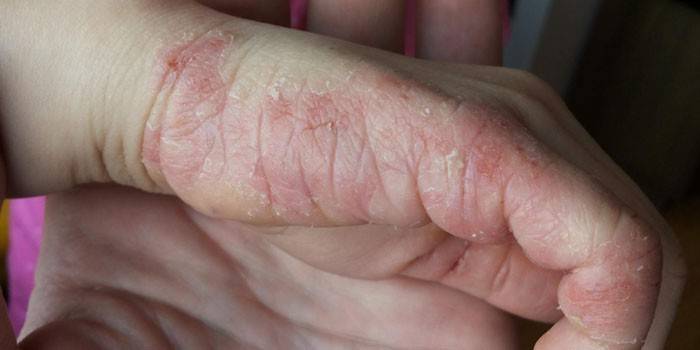 Dermatitis atópica en la palma de su mano.