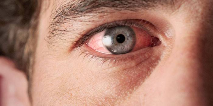 El hombre tiene dolor en el ojo